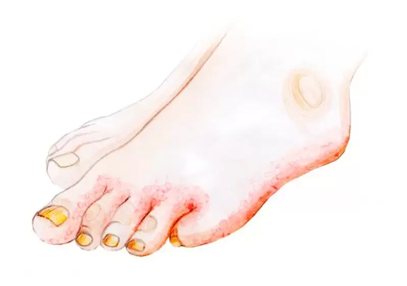 Ayak parmaklarında mantar ve Zenidol kreminin nasıl uygulanacağı