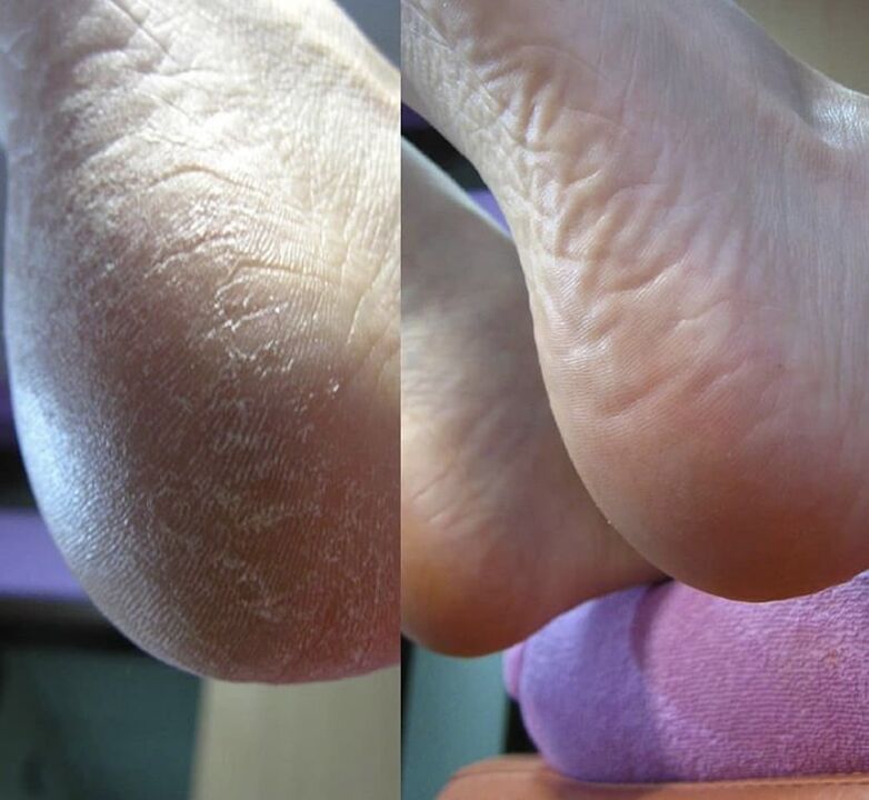 Zenidol kremini kullanmadan önce ve sonra ayak topuğunun fotoğrafı