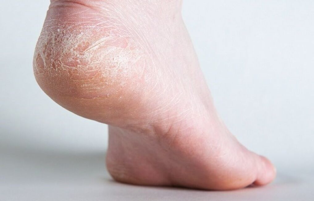 bacaktaki deri mantarı nasıl tedavi edilir