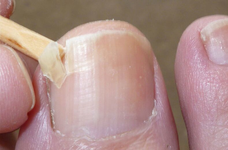 Hasarlı tırnaklar mantar enfeksiyonu için bir risk faktörüdür