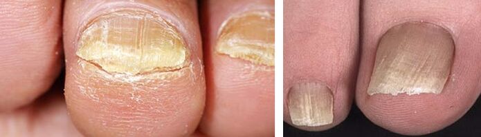 mantar enfeksiyonu olan tırnaklarda hasar