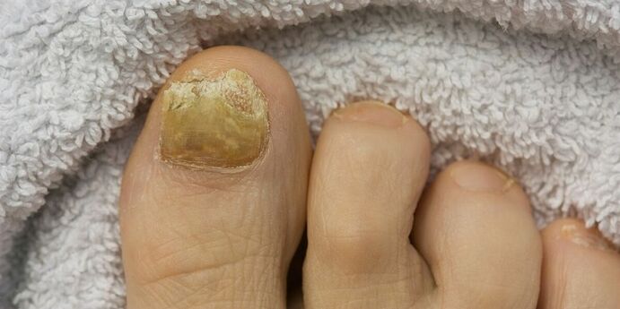mantar enfeksiyonlu sarı ayak tırnağı