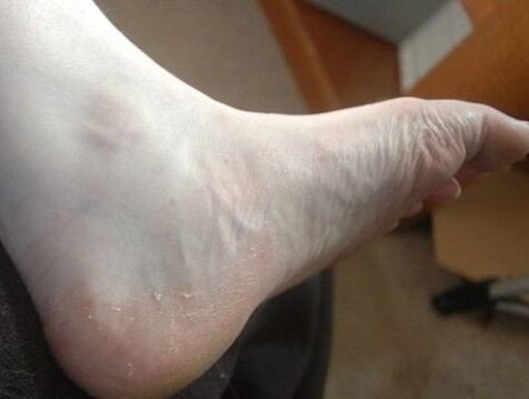 mantar enfeksiyonu belirtisi olarak bacak ayağının soyulması